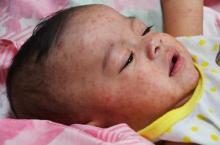 measles-rash